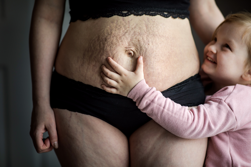 postpartumproject_ker-fox_photography_stretchmarks.png